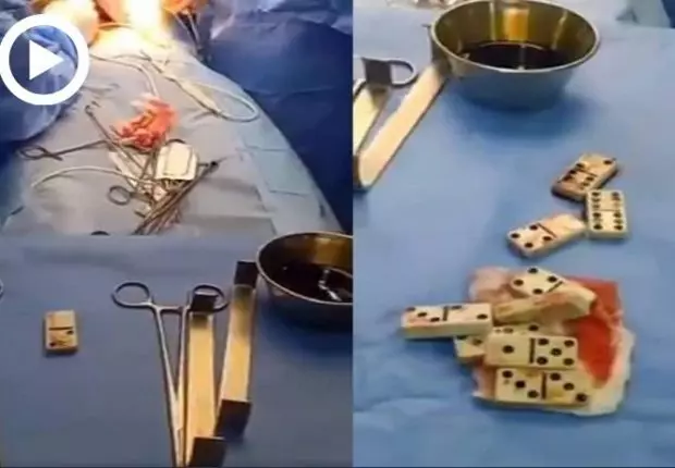 Vidéo. 10 pièces de domino retrouvées dans le ventre d’un patient