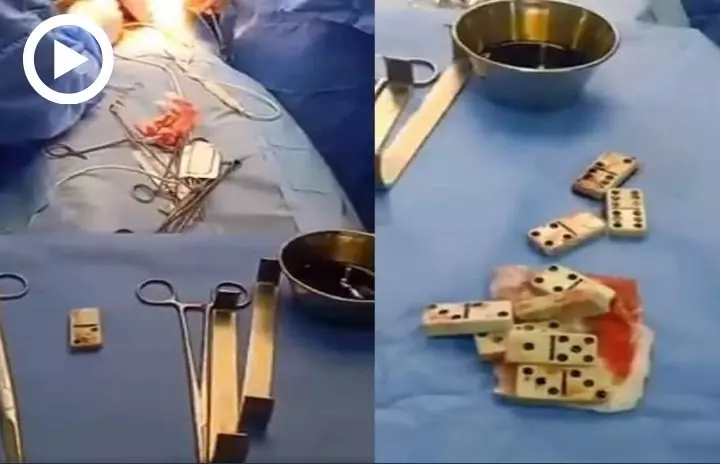 Vidéo. 10 pièces de domino retrouvées dans le ventre d’un patient
