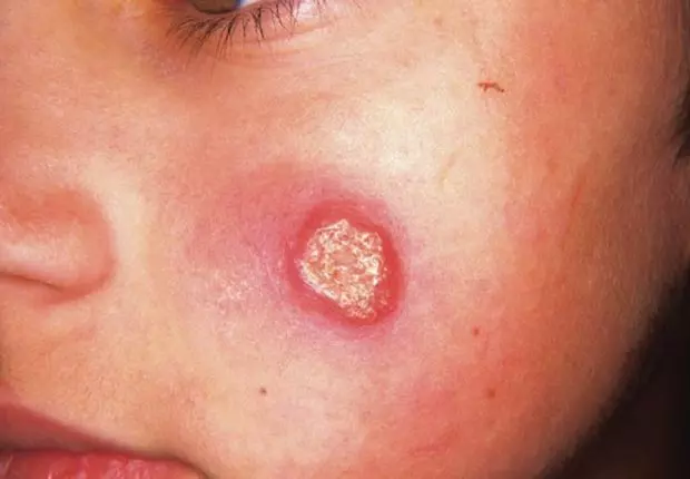 Tébessa : prés de 2000 cas de leishmaniose cutanée à Bir El Ater