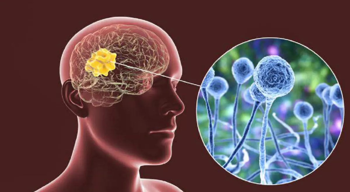 Après le noir, un nouveau champignon mortel menace l’Inde