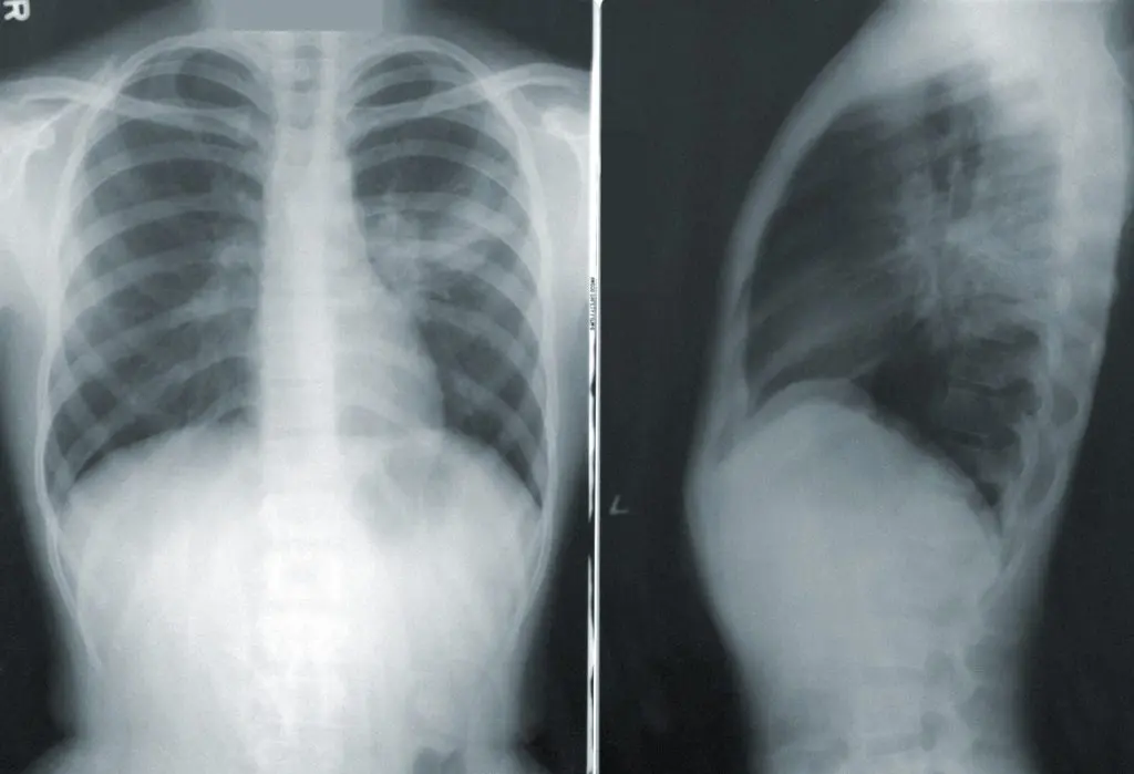 Sommet sur les maladies pulmonaires interstitielles : l&rsquo;Algérie présente