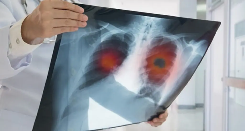 Cancer du poumon : de nouvelles thérapies prometteuses