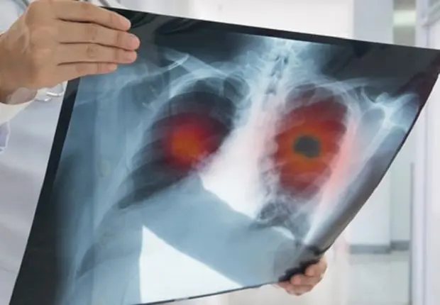 Cancer du poumon : de nouvelles thérapies prometteuses