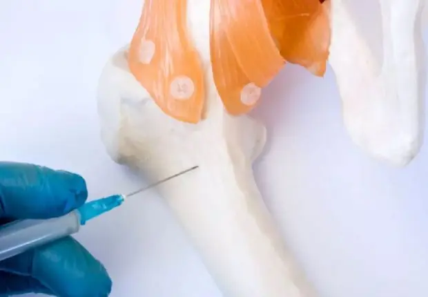 Greffe de moelle osseuse : ce qu’il faut savoir