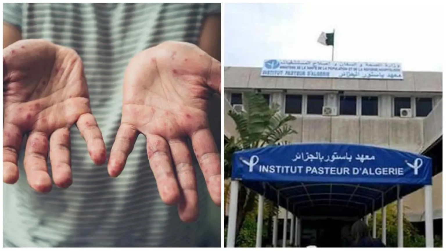 Variole du singe : note importante de l’Institut Pasteur d’Algérie