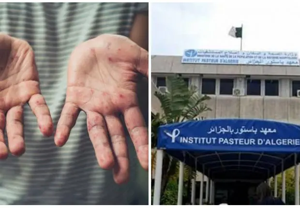 Variole du singe : note importante de l’Institut Pasteur d’Algérie