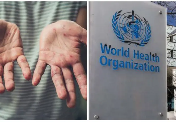 Variole du singe : l’OMS émet des mises en garde