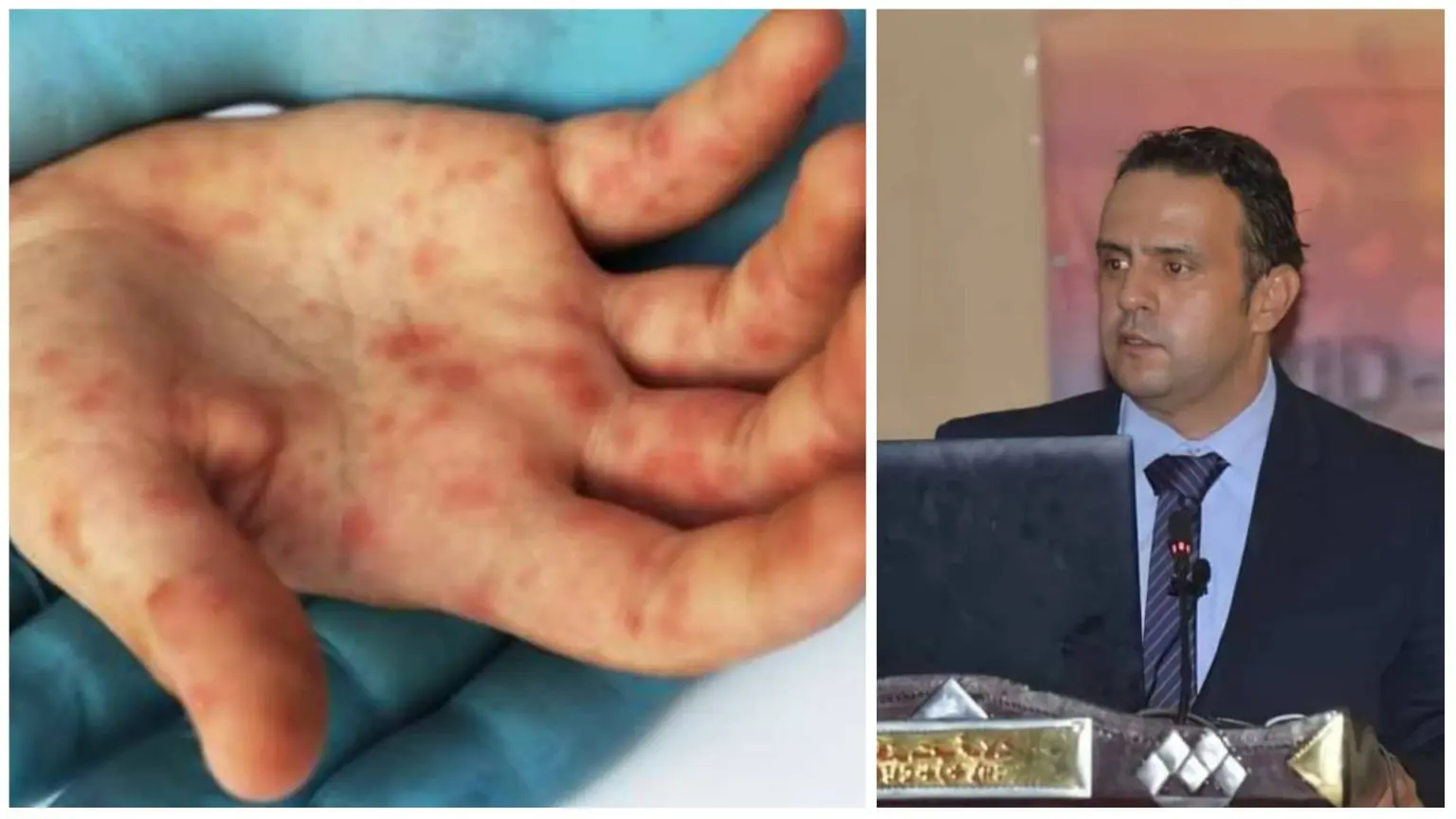 Variole du singe : Dr Akhamouk met en garde