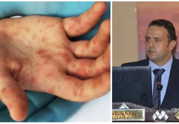 Variole du singe : Dr Akhamouk met en garde