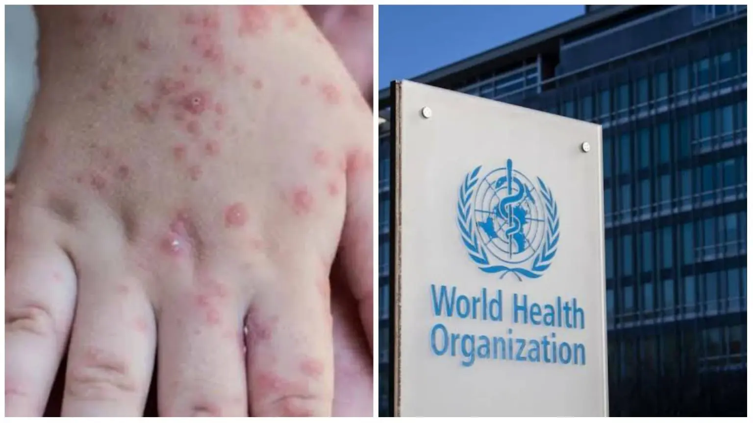 Variole du singe dans le monde : l’OMS livre les derniers chiffres