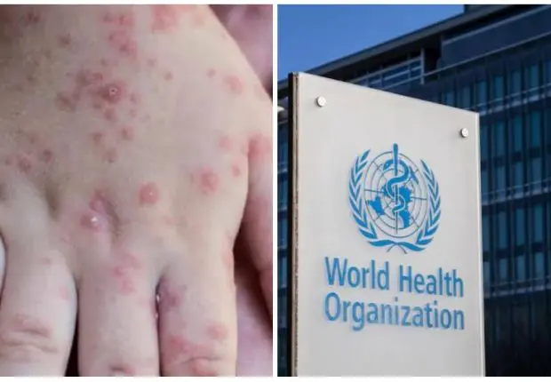 Variole du singe dans le monde : l’OMS livre les derniers chiffres