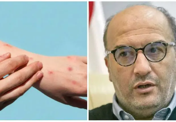 Variole du singe en Algérie : Derrar fait le point sur la situation