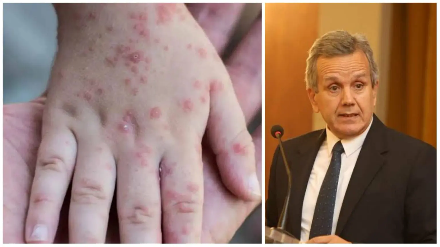 Variole du singe : « l’Algérie y est préparée » selon Benbouzid