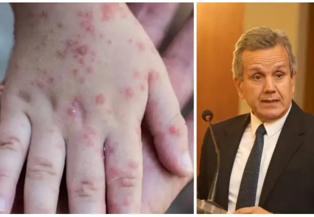 Variole du singe : « l’Algérie y est préparée » selon Benbouzid