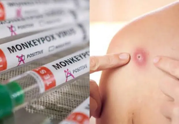 La variole du singe, c’est quoi ? Est-elle dangereuse et mortelle ?