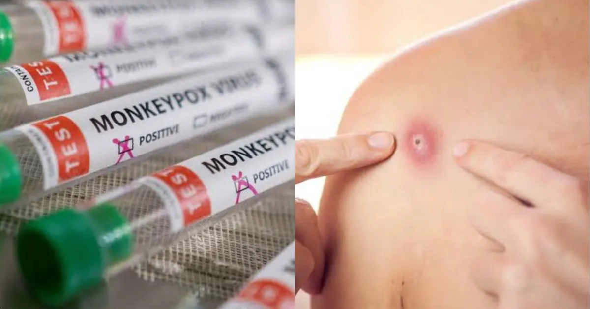 La variole du singe, c’est quoi ? Est-elle dangereuse et mortelle ?