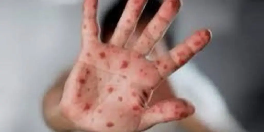 Variole du singe : l’OMS communique les chiffres