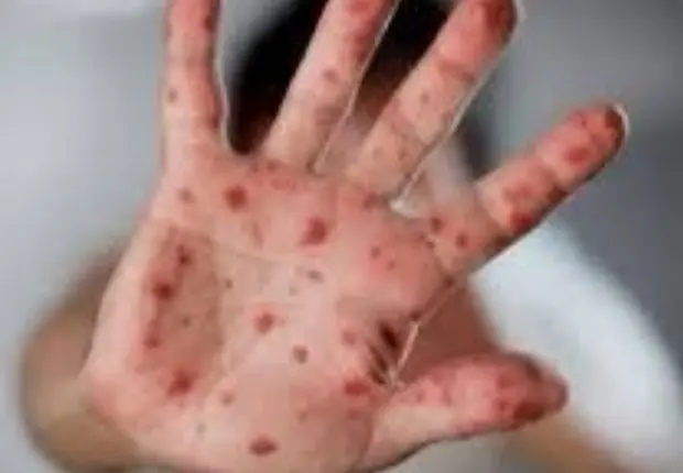 Variole du singe : l’OMS communique les chiffres