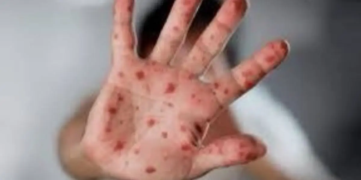 Variole du singe : l’OMS communique les chiffres