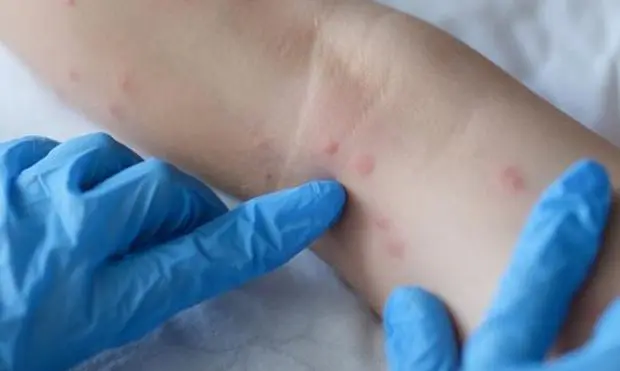 Variole du singe en Algérie : mise en place d’une commission de suivi