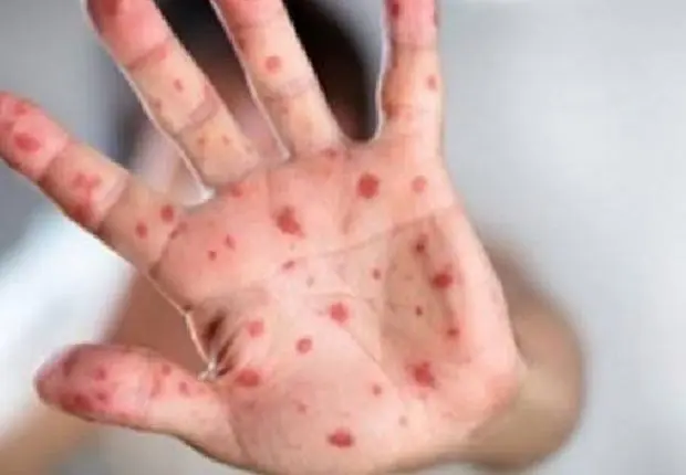 Variole du singe : 8 pays africains touchés