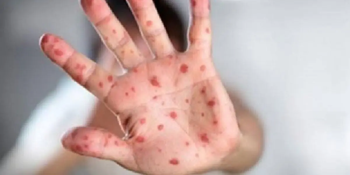 Variole du singe : 8 pays africains touchés