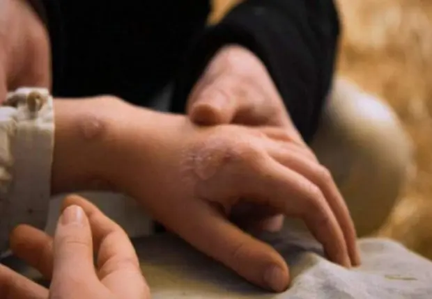Variole du singe : le Maroc enregistre son premier cas