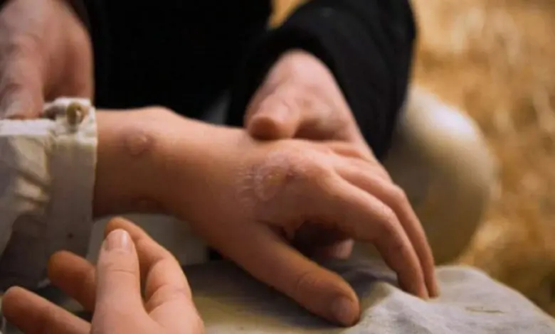 Variole du singe : le Maroc enregistre son premier cas