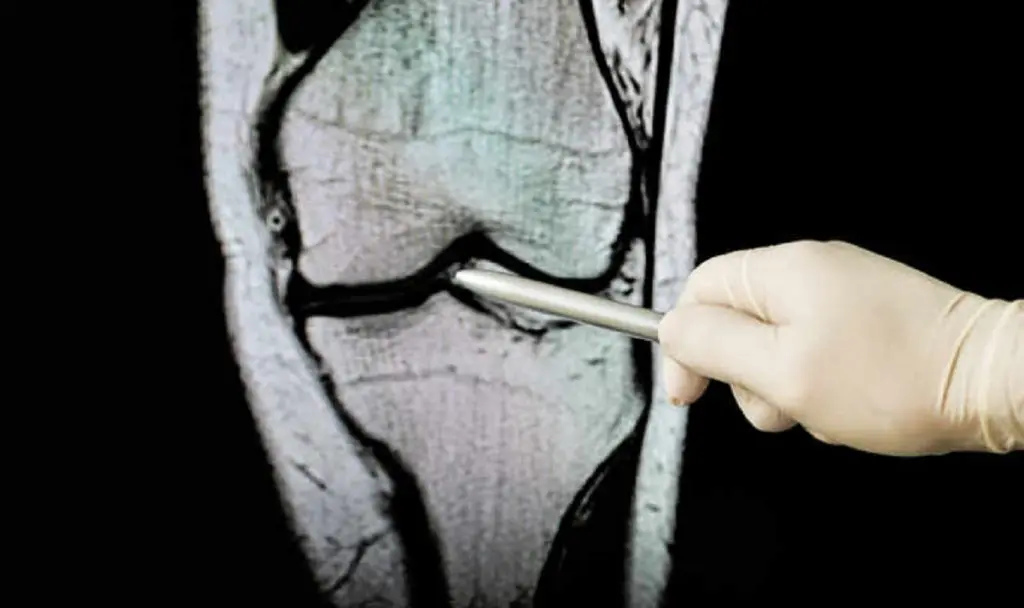 Ostéoporose et traitement des fractures vertébrales : ce que propose le Centre médical Anadolu