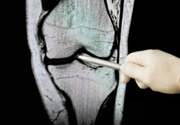 Ostéoporose et traitement des fractures vertébrales : ce que propose le Centre médical Anadolu