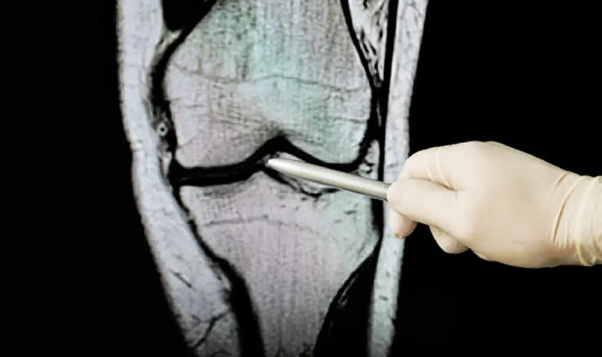 Ostéoporose et traitement des fractures vertébrales : ce que propose le Centre médical Anadolu