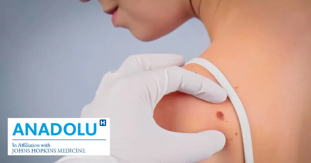 Traitement du mélanome (cancer de la peau) par l’immunothérapie au Centre Médical Anadolu