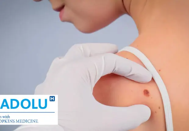 Traitement du mélanome (cancer de la peau) par l’immunothérapie au Centre Médical Anadolu