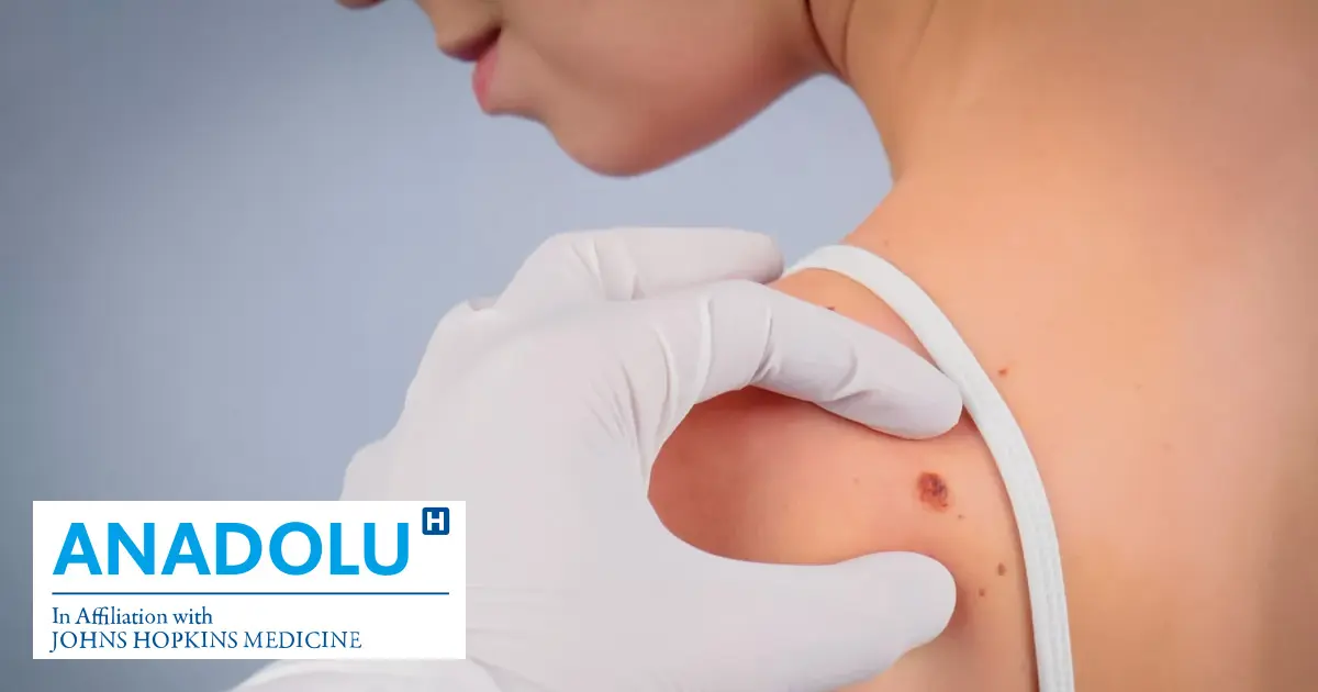 Traitement du mélanome (cancer de la peau) par l’immunothérapie au Centre Médical Anadolu