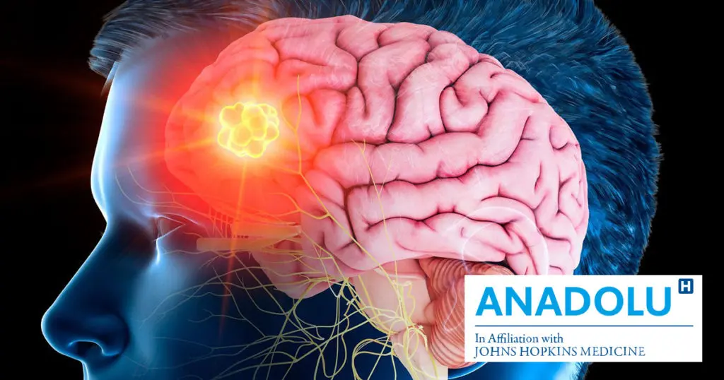 Que savez-vous sur le MÉNINGIOME, la tumeur du cerveau la plus courante ?