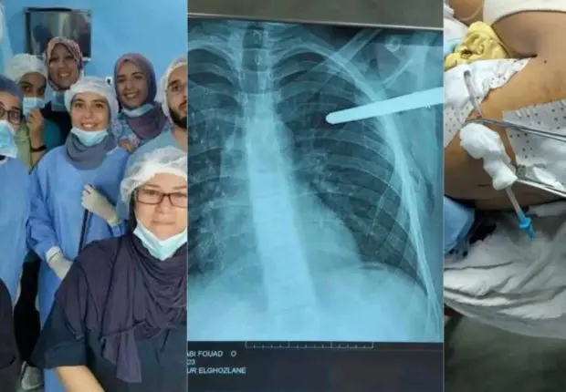 L’équipe médicale du CHU Mustapha sauve un adolescent transpercé par une barre métallique (IMAGES)