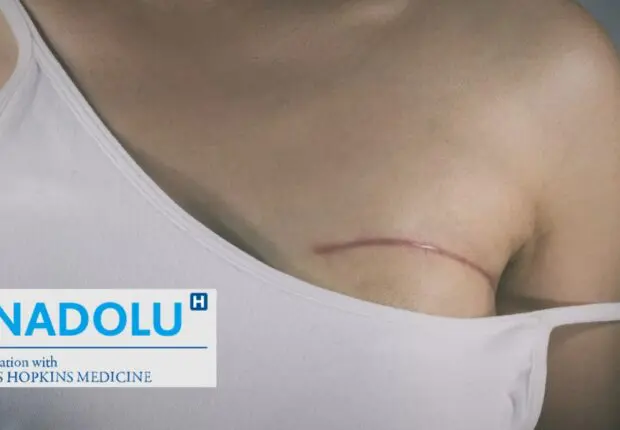 Lumpectomie : la chirurgie mammaire conservatrice du cancer du sein