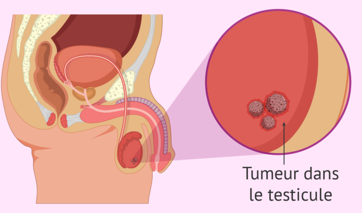 Cancer des testicules