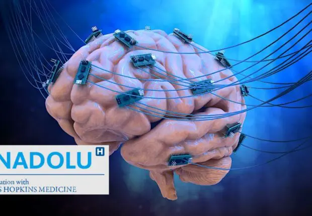 Maladies neurologiques : la stimulation cérébrale profonde (DBS) change la donne