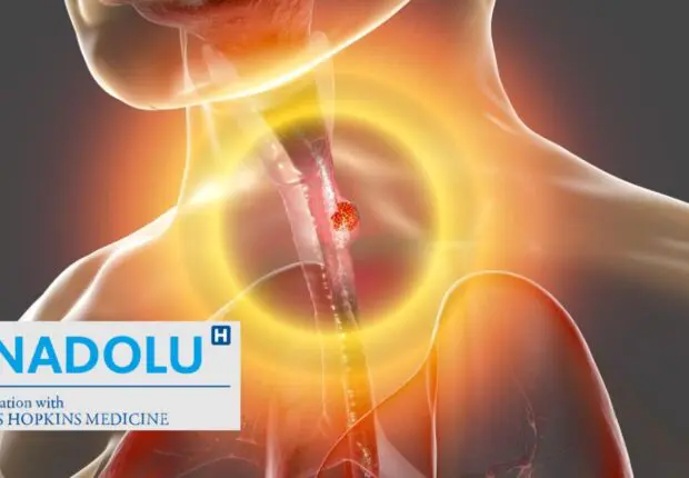 CANCER DE L’ŒSOPHAGE : Symptômes et Traitement (Centre Médical Anadolu)