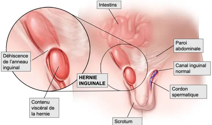 hernie inguinale