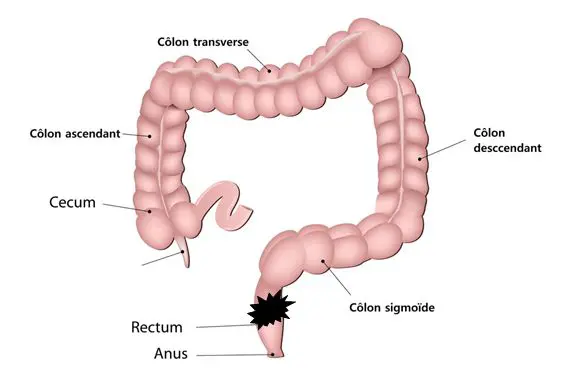 Cancer du rectum (schéma)