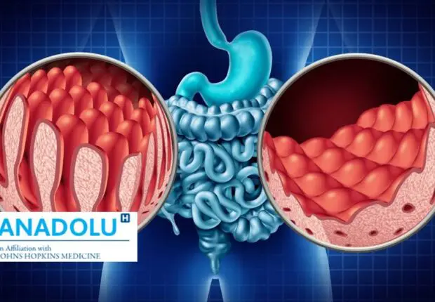 La maladie cœliaque expliquée : causes, symptômes, traitement et prévention !