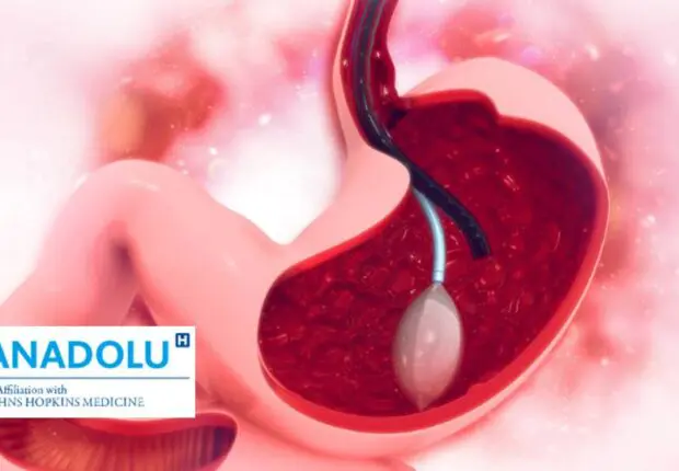 Guide complet sur le ballon gastrique avalable : utilisation, efficacité et avantages !