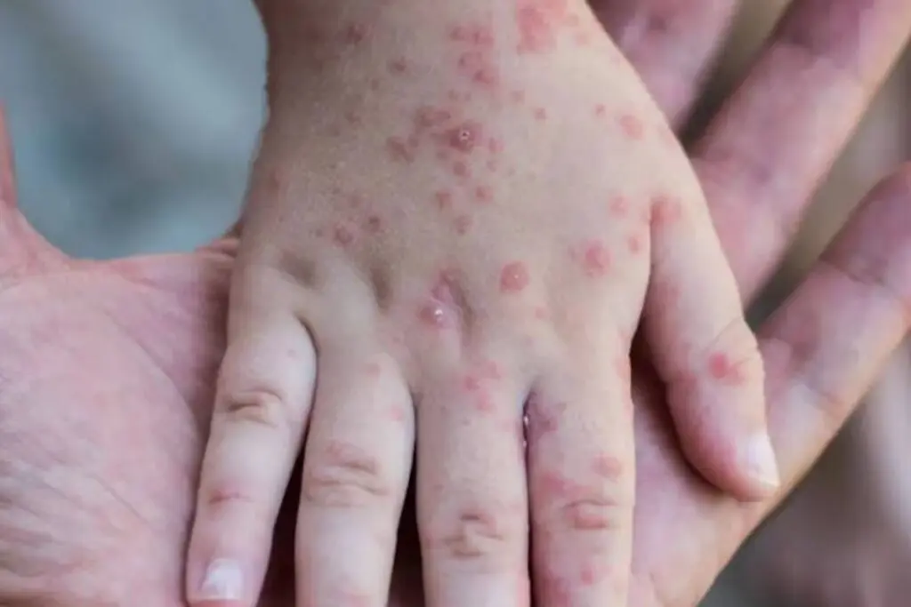 Mpox : l&rsquo;Algérie renforce sa défense face à la menace de la variole du singe