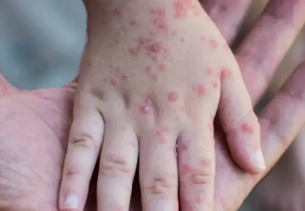 Mpox : l’Algérie renforce sa défense face à la menace de la variole du singe