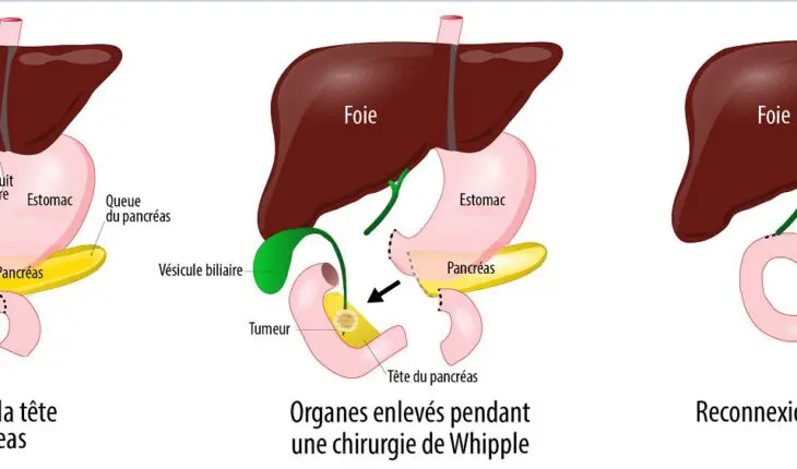 Chirurgie de Whipple (schéma)