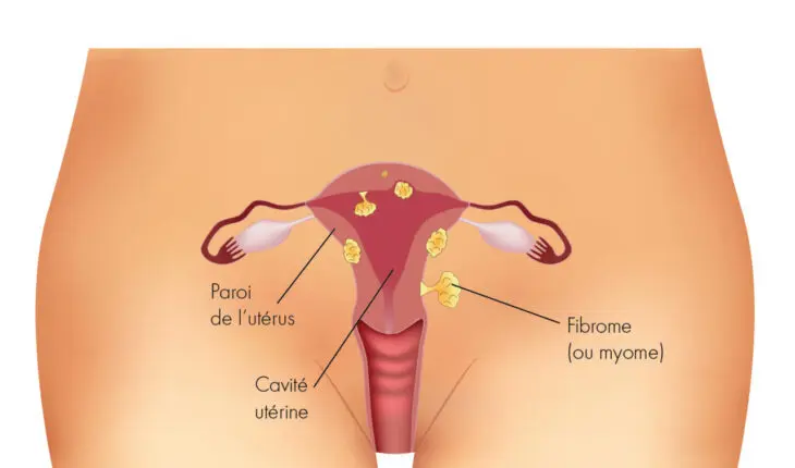 fibrome utérin