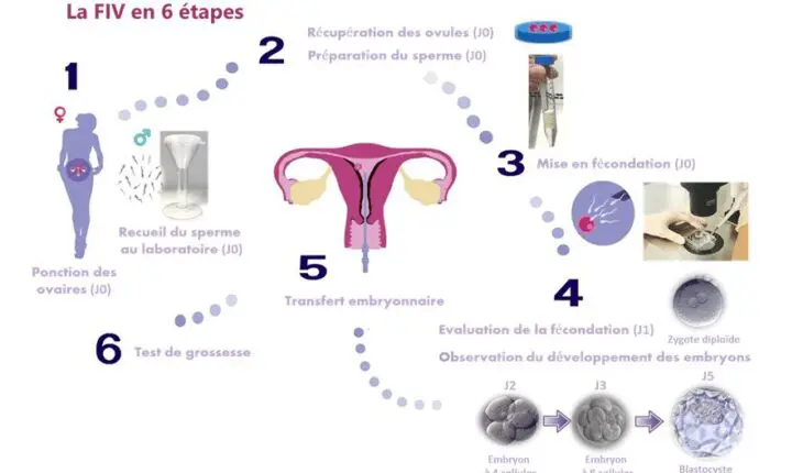 Les six étapes de la fécondation in vitro (FIV)