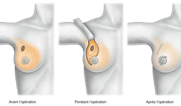 chirurgie du sein : tumorectomie